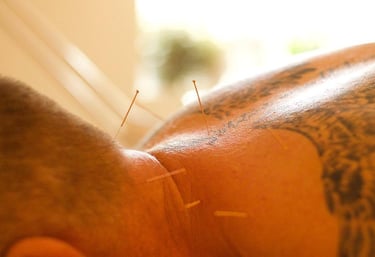 Close up of the back of a mans neck with acupuncture needles in