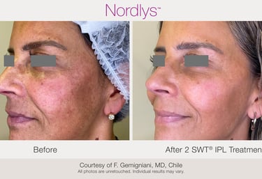 before and after acne and skin treatment results in Hamilton clinic