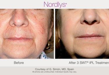 Redness & Rosacea Treatment in Hamilton, Ontario