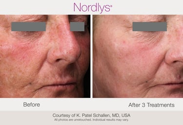 professional redness and vascular skin treatment for rosacea in Hamilton clinic