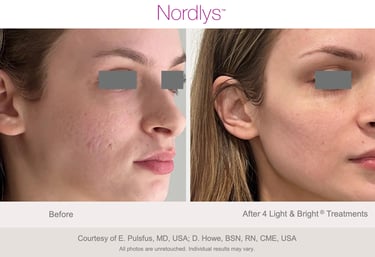 before and after pigmentation and skin improvement treatment results in Hamilton Ontario