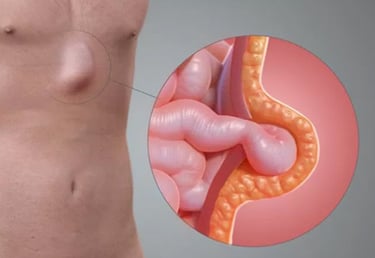 Imagem ilustrativa Hérnia Epigástrica