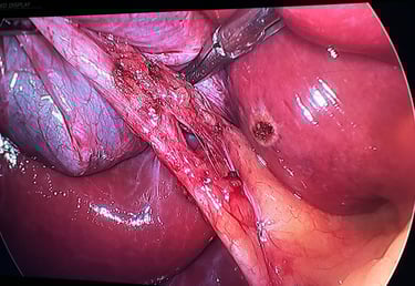 realizando a cirurgia de calculos biliares