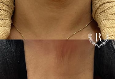 bioestimulador de colágeno aplicação facial - clínica estética Tatuapé