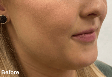 Before QuantumRF Treatment
