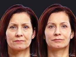 Botox Treatment Before and After
