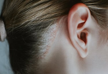 psoriasis en cuero cabelludo en mujer con escamas y eritema detras de la oreja