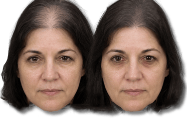 Before and after comparison of a woman's scalp showing effective hair loss treatment and regrowth.