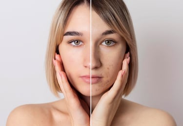 microneedling before and after removed scars