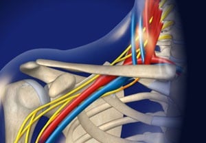 vascular ultrasound thoracic outlet syndrome arm pain cold white hand numbness tingling compression rib blood clot vein nerve