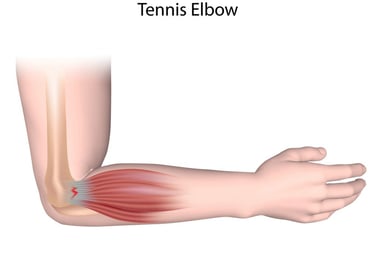 Dr.Rajinikanth's ortho clinic tennis elbow