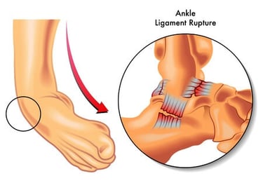 ankle sprain treatment