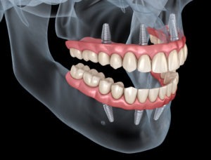 Protese sobre implantes All on four