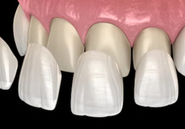 Facetas e lentes do contato odontológico para melhorar a estetica do sorriso