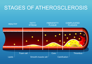 vascular ultrasound artery atherosclerosis stenosis disease stent bypass graft leg pain walking claudication peripheral block