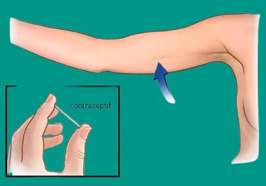 implant contraceptif, contraception, anti grossesse, recherchesante.com (1)