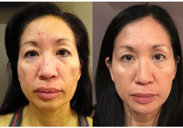 Before and after of woman skin clearer 