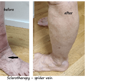 Legs with spider veins before and 6 weeks after sclerotherapy – clear reduction of spider veins.