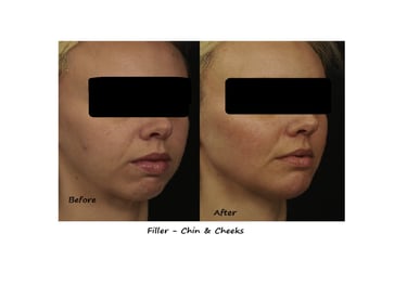 Before and after photos filler chin & cheeks – restored volume and proportions, a harmonious face.