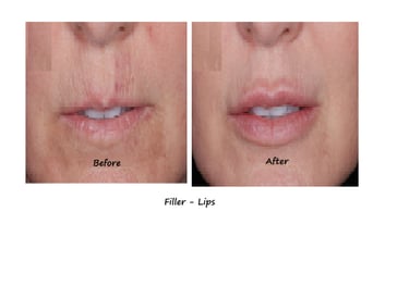 Before and after photos filler lips– more volume, fewer wrinkles around the mouth, natural shape