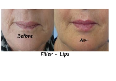 Before and after photos filler lips– more volume, fewer wrinkles around the mouth, natural shape.