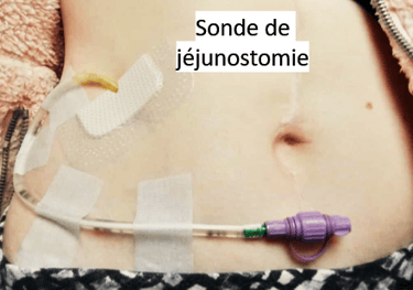 jéjunostomie