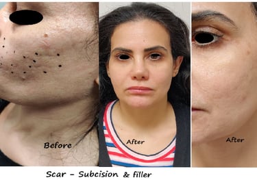 Före/efter ärrbehandling med subcision + filler – slätare hud, minskade akneärr.