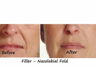 Before and after photos Filler nasolabial folds – smoother contour & younger appearance after filler