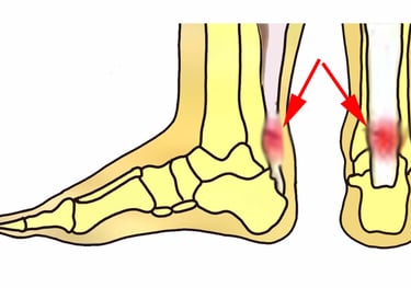 image of achilles tendinitis