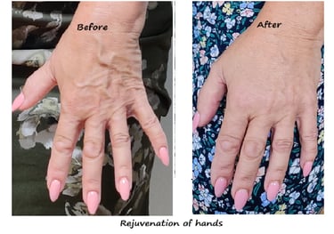 Före/efter handfiller – minskade vener, återställd volym och slätare hud.
