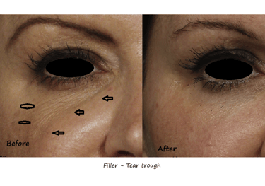 Before and after photos filler tear trough – reduced dark circles, smoother transition to cheeks.