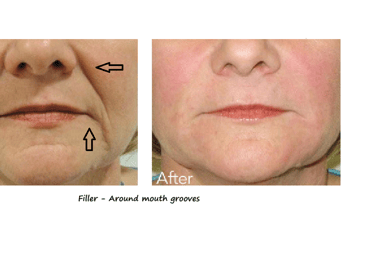 Before and after photos filler around the mouth – reduced groves, smoother contours and younger look