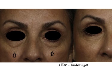 Före/efter filler tear trough – reducerade mörka ringar, slätare övergång mot kinder.