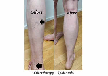 Before & after spider veins treatment Delhi – leg veins reduced 8 weeks after sclerotherapy.
