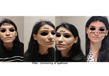 Before and after photos filler eyebrows contour – softer brows, lifted and harmonious face.
