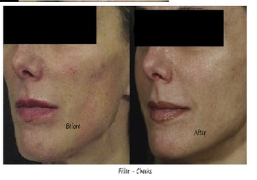 Before and after mid-face fillers in Bangalore. Cheeks gain contour and volume, smooth and natural.