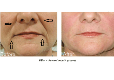 Before and after photos filler around the mouth – reduced groves, smoother contours and younger look