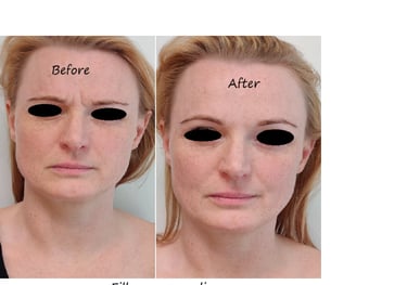 Före/efter glabellafiller – reducerade rynkor och slätare panna.