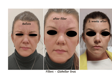 Before and after photos filler glabella – smooth glabella without wrinkles for a pleasant expression