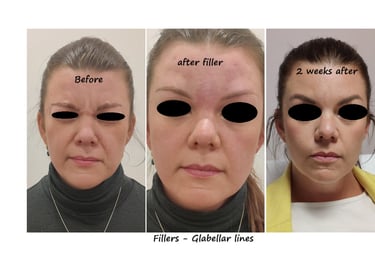 Före och efterbild filler glabella – slät glabella utan rynkor för ett mer behagligt uttryck.