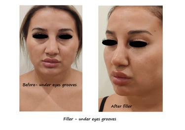 Före- & efterbild filler under ögonen – reducerade mörka ringar och yngre, piggare utseende.