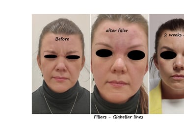 Före och efterbild filler glabella – slät glabella utan rynkor för ett mer behagligt uttryck.
