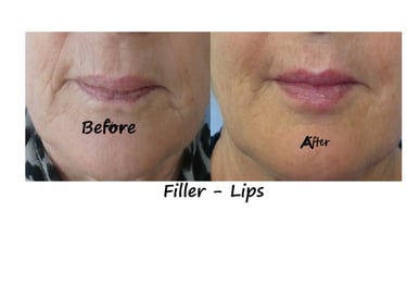 Before and after photos filler lips – restored volume, harmonious face & reduced lines around mouth.