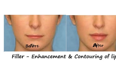 Before and after photos filler lips – increased volume, better contour and harmonious face. 