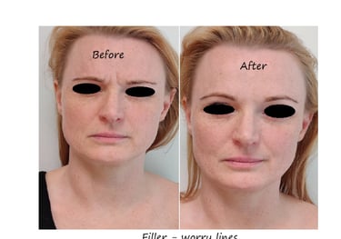 Before and after photos glabella filler – reduced wrinkles and smoother forehead.