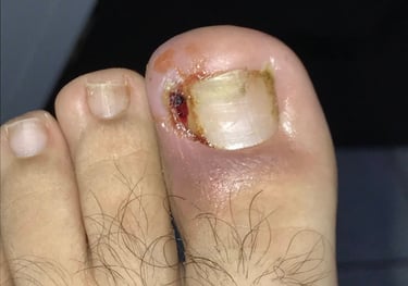 tratamiento uña encarnada Podocenter