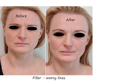 Före/efter glabellafiller – reducerade rynkor och slätare panna.