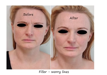 Före- och efterbild filler glabella – reducerade linjer och slätare panna.