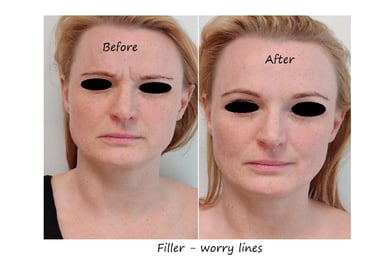 Before and after photos glabella filler – reduced wrinkles and smoother forehead.