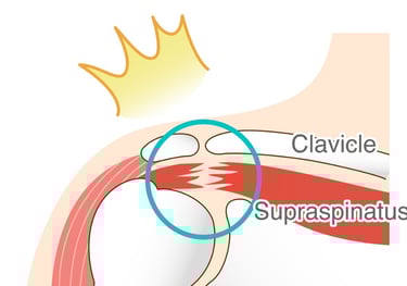 anatomic image of a torn rotator cuff muscle highlighted to indicate pain